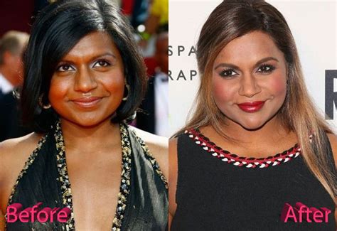 mindy kaling plastic surgery|Mindy Kaling’s Plastic Surgery: The 43